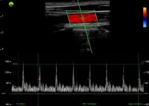 Carotid 2