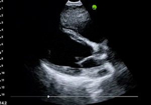 Parasternal long axis view